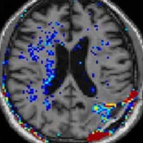 MRI של חולה הסובל מגידול מגידול ממאיר ראשוני