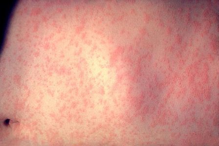 Morbillivirus_measles_infection large.jpg